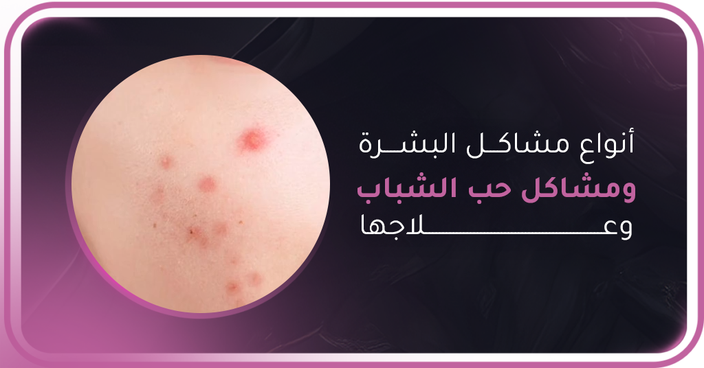 أنواع مشاكل البشرة ومشاكل حب الشباب وعلاجها
